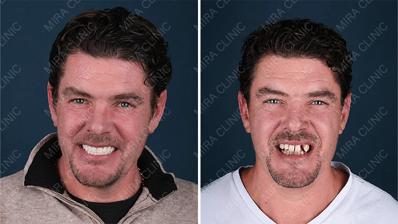 Before and after Dental implants
